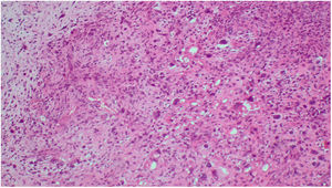 A y B) Componente sarcomatoide, pleomórfico de alto grado, con franca anaplasia nuclear, símil sarcoma pleomórfico indiferenciado.