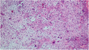 A y B) Componente sarcomatoide, pleomórfico de alto grado, con franca anaplasia nuclear, símil sarcoma pleomórfico indiferenciado.