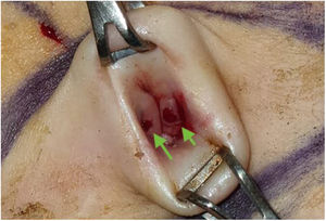 Physical examination: navel with two small and bluish lesions.