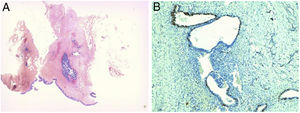 (A) Hematoxylin–eosin with magnifying glass: a nodule is located within the fibrous tissue revealing an increased number of endometrial glands attached to each other. (B) Ki67 ×100: in the glandular epithelium a moderate cell proliferation index is shown, estimated at 10% of the nuclei.