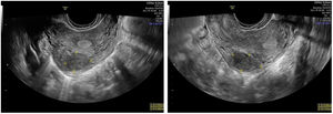 (A and B). Transvaginal ultrasound described a hypoechoic subserosal-intramural mass (FIGO leiomyoma subclassification system: O-4) localized in the posterior uterine wall, measuring 23mm×19mm×13mm, slightly vascularized at the Color-Doppler (Color Score 2).
