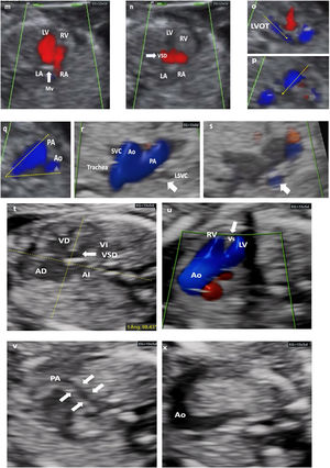 Different cardiac anomalies detected during the first trimester of pregnancy. Abbreviations: St: Stomach. dAo: Descending aorta. IVC: Inferior Vein Cava. Uv: Umbilical vein. Sp: Spine. RA: Right atrium. LA: Left atrium. RV: Right ventricle. LV: Left ventricle. Mv: Mitral valve. Tv: Tricuspid valve. LVOT: Left ventricular outflow tract. Vs: Ventricular septum. RVOT: Right ventricular outflow tract. PAv: Pulmonary valve. LPA: Left pulmonary branch. RPA Right pulmonary branch. PA: Pulmonary Artery. Duct: Ductus arteriosus. Ao: Aorta. SVC: Superior vein cava. Trachea. PS: Septum primum. SS: Septum secundum. FO: Foramen ovale. AA: Supra-aortic trunks. (m–q) Mitral atresia. (m and n) 4C view. Color Doppler. 4C section demonstrating an interventricular septal defect (VSD) that allows LV filling, despite the absence of flow passage through the mitral valve, which appears hyperrefringent and thickened (thick arrow). either. LVOT with a very small caliber Ao (dashed arrow). (p) RVOT, normal caliber (dashed arrow), with crossed paths. (q) 3V view (2V in this case) framed by dashed lines (V) with an Ao of very small caliber. (r and s) 3VT view. Color Doppler. LSVC persistence (thick arrow). Confluent antegrade flow. From left to right and from largest to smallest caliber. PA, Ao, SVC. The aortic arch is left. (t–x) Tetralogy of Fallot. (t) Very horizontal heart. Measurement of cardiac axis at 98° (dashed yellow lines. Interventricular septal defect (thick arrow). (u) LVOT with color Doppler. Ao rides over the septum and fills both ventricles through subaortic interventricular septal defect. (v) RVOT exiting of the RV with severe stenosis (filiform). (x) Very striking transverse aorta, no possible identification of normal 3V section. Note the great asymmetry of the great vessels.