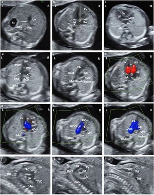 (a) Situs solitus. Axial section of the upper abdomen. (b) Apical section 4CV. Situs solitus. Observe pulmonary vein drainage (dashed arrows) in LA, moderator band in RV, and most apical insertion of the Tv. Cardiac axis, angle measurement (dashed yellow line). (c) LVOT section from LV in continuity with Mv and Vs. (d) Section RVOT from the RV. Observe the closed PAv and the bifurcation of the main pulmonary trunk in RPA and LPA. (e) Section of 3V trachea. From left to right and of decreasing size: PA and its continuity with the RA, Ao and SVC. Observe the Trachea that defines the position of the AA as left. (f) Color Doppler in apical 4CV section. Antegrade flow through the atrioventricular valves, with normal biventricular filling. AI with pulmonary vein drainage (dashed arrows). Observe PS, SS and FO. (g) LVOT color Doppler with laminar antegrade flow. (h) Color Doppler in RVOT with laminar antegrade flow. (i) Color Doppler in 3V trachea section. From left to right and of decreasing size: PA (continuity with the Duct), Ao and SVC. Anterograde laminar flow, observing that both PA and Ao code in the same color. (j) Sagittal section of the AA and LVOTT. (k) Sagittal section Ductal arch. (l) Bicave section. Abbreviations: St: Stomach. dAo: Descending aorta. IVC: Inferior Vena Cava. Uv: Umbilical vein. Sp: Spine. RA: Right atrium. LA: Left atrium. RV: Right ventricle. LV: Left ventricle. Mv: Mitral valve. Tv: Tricuspid valve. LVOT: Left ventricular outflow tract. Vs: Ventricular septum. RVOT: Right ventricular outflow tract. PAv: Pulmonary valve. LPA: Left pulmonary branch. RPA Right pulmonary branch. PA: Pulmonary Artery. Duct: Ductus arteriosus. Ao: Aorta. SVC: Superior vein cava. IVC: Inferior vein cava Trachea. PS: Septum primum. SS: Septum secundum. FO: Foramen ovale. AA: Supra-aortic trunks.