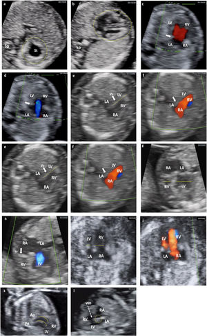 Different cardiac anomalies detected during the first trimester of pregnancy. Abbreviations: St: Stomach. dAo: Descending aorta. IVC: Inferior Vein Cava. Uv: Umbilical vein. Sp: Spine. RA: Right atrium. LA: Left atrium. RV: Right ventricle. LV: Left ventricle. Mv: Mitral valve. Tv: Tricuspid valve. LVOT: Left ventricular outflow tract. Vs: Ventricular septum. RVOT: Right ventricular outflow tract. PAv: Pulmonary valve. LPA: Left pulmonary branch. RPA Right pulmonary branch. PA: Pulmonary Artery. Duct: Ductus arteriosus. Ao: Aorta. SVC: Superior vein cava. Trachea. PS: Septum primum. SS: Septum secundum. FO: Foramen ovale. AA: Supra-aortic trunks. (a and b) Alteration of situs. Situs inversus. Note how the fetal heart and stomach (on the right side of the upper abdomen) are not on the same side. (c and d) Color Doppler. No visualization of the crux cordis and flow passage through a single valve orifice. Complete atrioventricular septal defect. (e and f) Mitral atresia. Striking asymmetry of cavities, the left ones being very small (thick arrow). Color Doppler: antegrade flow through the tricuspid valve and absent through the mitral valve. (g and h) Tricuspid atresia. Significant asymmetry between both cavities at the expense of less development of the RV (dashed lines). Color Doppler: absence of flow through the tricuspid valve, which appears hyperrefringent and thickened (thick arrow). Anterograde transmitral flow. (i and j) Suspected Coarctation of the Aorta, later confirmed. Marked asymmetry of cavities with predominance of right cavities (dashed arrows). Color Doppler with antegrade filling of both ventricular cavities, although asymmetric. (k) Transposition of great arteries. Exit of great vessels in parallel, with ventriculo-arterial discordance, such that the Ao leaves the anterior RV and the PA leaves the posterior LV (dashed lines). (l) Interventricular septal defect (dashed arrow). Observe the integrity of the Crux cordis.