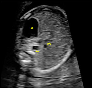 Upper abdomen (situs) view. Ao, aorta; IVC, inferior vena cava; St, stomach.
