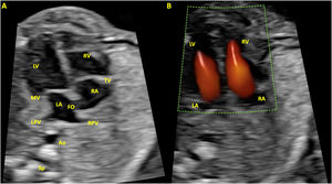 Apical four chamber view. (A) B-mode, in systole, with both atrioventricular valves closed. (B) With color Doppler, in diastole, with the valves open. LV, left ventricle; RV, right ventricle; MV, mitral valve; TV, tricuspid valve; LA, left atrium; RA, right atrium; LPV, left pulmonary vein; RPV, right pulmonary vein; Ao, aorta; Sp, spine; FO, foramen ovale.