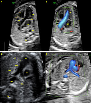 Left ventricular outflow tract view or five-chamber view in systole. (A) B-mode. (B) With color Doppler. The aortic valve is completely open and cannot be seen. Color Doppler demonstrates normal antegrade flow. Right ventricular outflow tract view in systole. (C) B-mode. (D) With color Doppler. The pulmonary valve is completely open and cannot be seen. LV, left ventricle; RV, right ventricle; MV, mitral valve; AoV, aortic valve; Ao, aorta; LA, left atrium; PV, pulmonary valve; MPA, main pulmonary artery; LPA, left pulmonary artery; RPA, right pulmonary artery; DAo, descending aorta; Sp, spine.