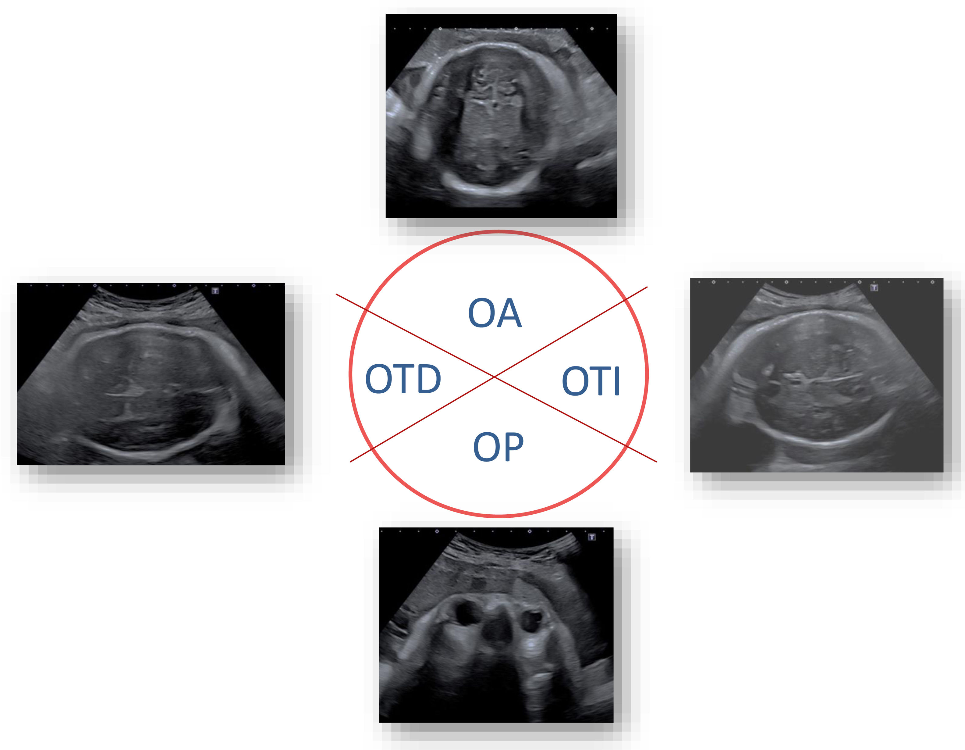 Methodology and utility of intrapartum ultrasound | Clínica e ...