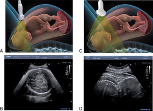 Cross-sectional transabdominal approach (A) with ultrasound image obtained (B) and longitudinal approach (C) with ultrasound image obtained (D).