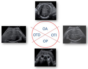 Representation of the position of the foetal head with respect to the clockwise axis13,21,22. OA: occiput anterior; OTD: right occiput transverse; OTI: left occiput transverse; OP: occiput posterior.