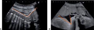 Assessment of the degree of head flexion via transabdominal route. (A) Occiput anterior (OA) foetuses, occipito-spinal angle. (B) Foetuses in occiput posterior (OP), chin–chest angle.