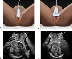 Sagittal transperineal approach (A) with ultrasound image obtained (B) and transverse (C) with ultrasound image obtained (D).