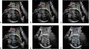 Main ultrasound measurements in transperineal ultrasound approach. (A) Angle of progression; (B) distance of progression, (C) head–symphysis-distance; (D) head direction; (E) head–perineum distance; (F) midline angle. In red: long axis of the pubic symphysis; in orange, infrapubic line; in green the main measurements.