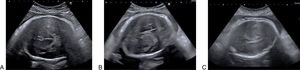 Ultrasound image of synclitism (A), anterior asynclitism (B) and posterior asynclitism (C).
