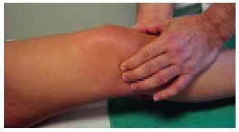 Caso Clínico: Artrosis de rodilla con varo severo que requiere dispositivos  especiales - Surbone