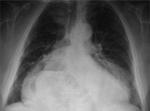 Radiografía de tórax. Nivel de la cámara de gases del estómago y del intestino en el hemitórax derecho.