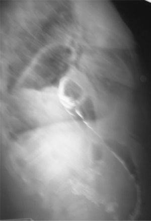 Enema opaco en que se observan las estructuras descritas en la radiografía simple de tórax.