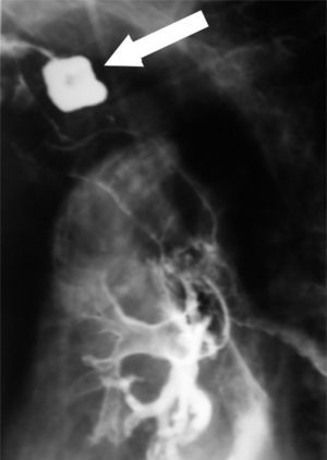 Imagen esofagoscópica: divertículo de Zenker (flecha) e imagen de broncograma debido a aspiración.
