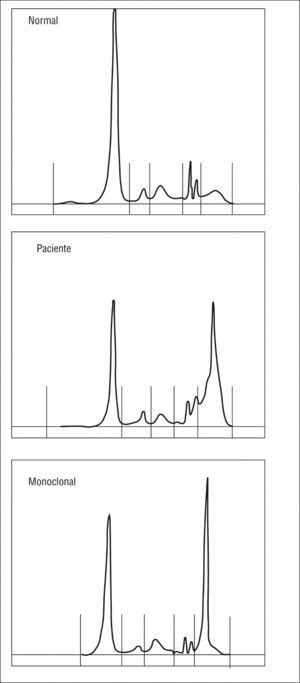 Espectro electroforético del suero.