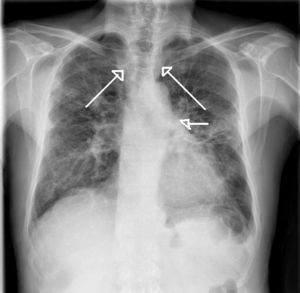 Radiografía posteroanterior de tórax. Se observa importante dilatación traqueal y bronquios principales.