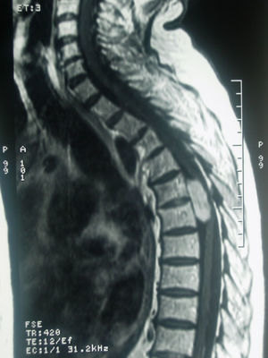 Imagen de TAC de columna dorsal lateral: neurinoma intradural, extramedular anterolateral de T5-T6.