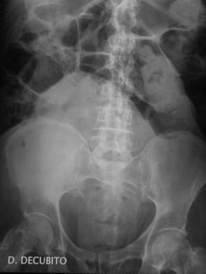 Radiografía simple del abdomen: masa en la pelvis que sugiere vejiga distendida.