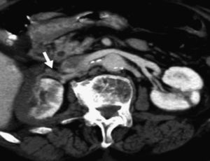 Reconstrucción axial de tomografía computarizada-angiografía que demuestra un defecto de repleción (flecha) secundario a trombosis en la rama prepiélica de la arteria renal derecha.