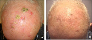 Paciente n.° 2. A) Costras y pústulas en cuero cabelludo. B) Excelente respuesta a tratamiento con pimecrólimus durante 4 semanas.