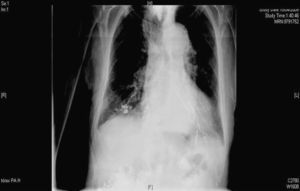 Radiografía tórax que muestra infiltrado alveolar bilateral por bario con broncograma aéreo.