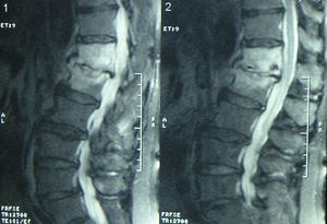 Imagen de resonancia magnética dorsolumbar donde se aprecia espondilodiscitis a nivel D12 y L1.