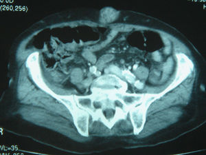 Tomografía axial computarizada toracoabdominal. Neoplasia de sigma y recto con infiltración local y numerosas adenopatías metastásicas.