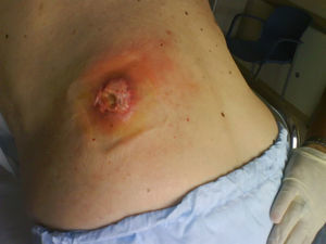 Fístula cutánea en región lumbar izquierda.