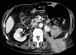 Imagen axial de TC con contraste i.v. Se observa masa de partes blandas mal definida con captación difusa de contraste que infiltra el polo inferior del riñón izquierdo con extensión hacia grasa perirrenal, e infiltración de músculo psoas izquierdo, musculatura lumbar y tejido celular subcutáneo.