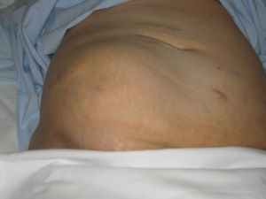 En abdomen presentaba una masa de consistencia pétrea en fosa iliaca derecha.