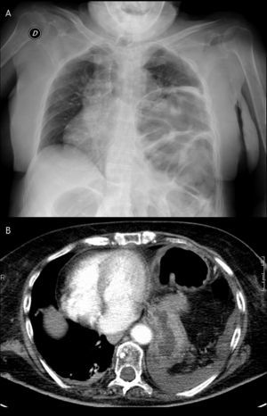 Herniación completa de colon izquierdo –volvulado–, estómago y bazo en el hemitórax izquierdo (A: Radiografía de tórax; B: TAC).