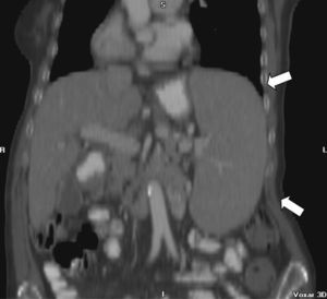 Tomografía computarizada de abdomen: esplenomegalia homogénea.
