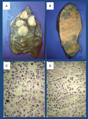 A y B) Imágenes de ambos pulmones que muestran las masas linfomatosas. C) Células neoplásicas de tamaño medio a grande, se identifican formas centrocitoides, plasmocitoides y numerosas células de aspecto blástico. Varias imágenes de mitosis. (hematoxilina-eosina, original x 400). D) Invasión del miocardio por células linfomatosas (hematoxilina-eosina, original x 200).