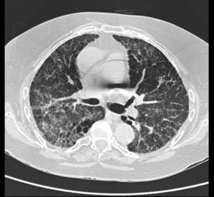 TAC de alta resolución: patrón en vidrio deslustrado, engrosamientos septales e imágenes quísticas en región paracardíaca derecha compatibles con fibrosis pulmonar.