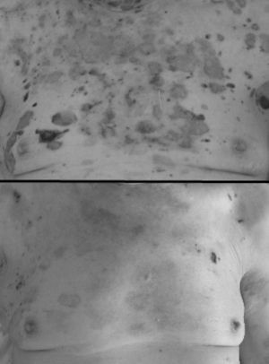 Evolución de las lesiones del tronco (días 1 y 36). Amplias zonas de piel ya denudada inicialmente exudativas que lentamente van reepitelizándose.