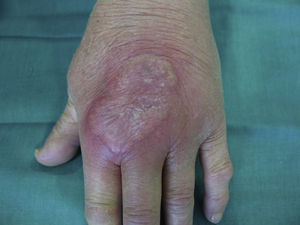 Placa eritematosa en el dorso de la mano izquierda, de borde pustuloso más acentuado de 3×3cm de diámetro.