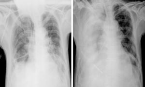 A) radiografía de tórax: sonda de nutrición en hemitorax derecho; B) radiografía de tórax tras introducción de alimentación enteral en parénquima pulmonar derecho.