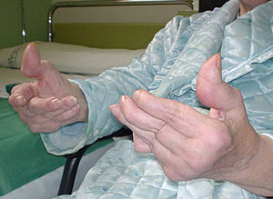 Artropatía degenerativa de Jaccoud en una mujer de 68 años con lupus eritematoso sistémico de larga evolución.