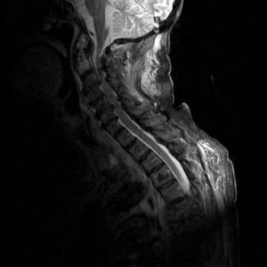 La RM muestra una fractura de odontoides con desplazamiento e hiperseñal STIR en toda la vértebra compatible con edema. Se aprecian además, signos de espondilosis con herniaciones discales múltiples C2-C7 con compromiso medular.