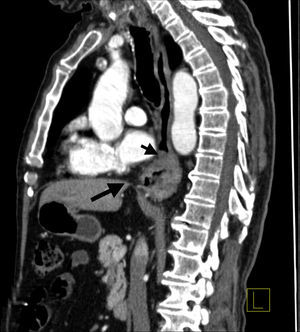 TC toracoabdominal donde se puede apreciar una tumoración estenosante en esófago distal (flecha pequeña) con estómago herniado en el mediastino (flecha grande).