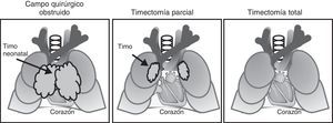 Posición anatómica del timo. En la figura se representa la necesidad de la timectomía para la corrección en enfermedades cardiacas congénitas y los diferentes procedimientos utilizados.