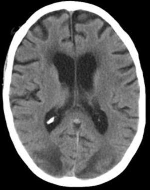 TC craneal en urgencias informa de hipodensidad bilateral occipital de predominio subcortical con borramiento de surcos que por su aspecto podría corresponder a un edema vasogénico; por la distribución y aspecto es sugestivo de SEPR.