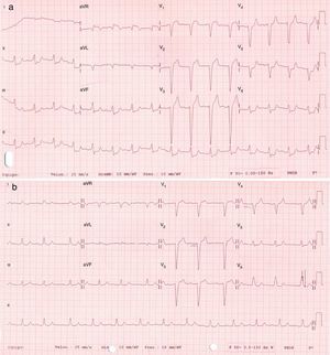 a) Primer electrocardiograma registrado en el Servicio de Urgencias; b) electrocardiograma realizado tras varias horas de ingreso.