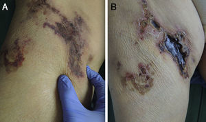 a) Nódulo con piel de color violáceo en zona de raíz inguinal derecha. b) Úlcera con escara necrótica de bordes eritematosos y geográficos en la localización donde previamente se situaba el nódulo.