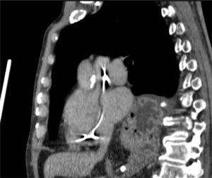 Tomografía computarizada donde se aprecia gran parte del estómago herniado en el mediastino, sin signos de sufrimiento y el corazón con un marcapasos intracavitario.