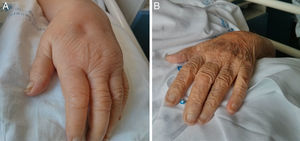 A) Se observa importante edema con fóvea a nivel de la mano izquierda. B) Evolución tras 48h de tratamiento: desaparición del edema de la mano.